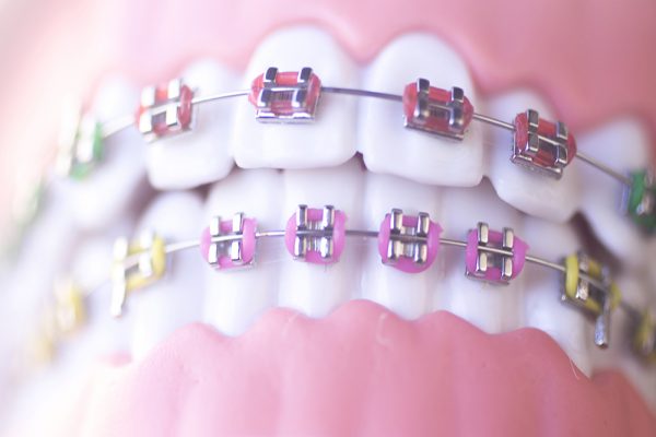 aparat ortodontyczny