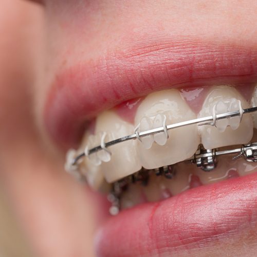 aparat ortodontyczny