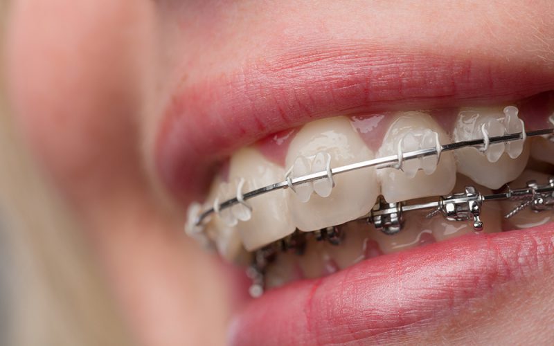aparat ortodontyczny