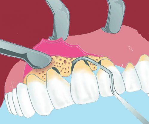 chirurgia stomatologiczna Wrocław kiretaż otwarty