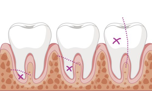 chirurgia stomatologiczna Wrocław resekcja hemisekcja radektomia